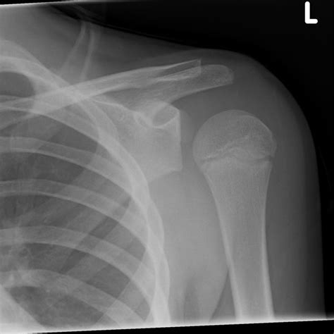 Lightbulb sign - shoulder dislocation | | Shoulder dislocation