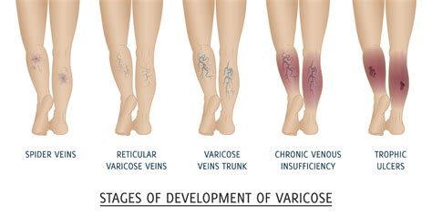 What Are Varicose Veins Varicose Veins Are Primarily Swollen By St Johns Vein Center Medium