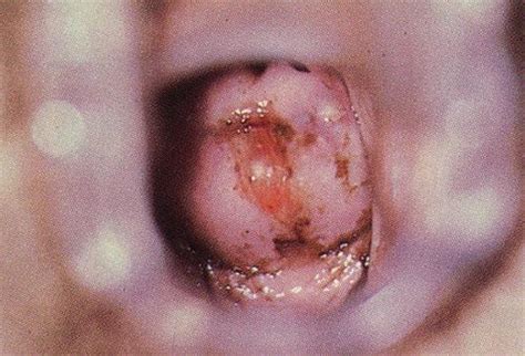 Doing it for just one period will be invaluable but doing it for three periods will enable you to spot patterns. A 46 Year Old Woman's Cervix And Menstrual Cycle - Womens ...