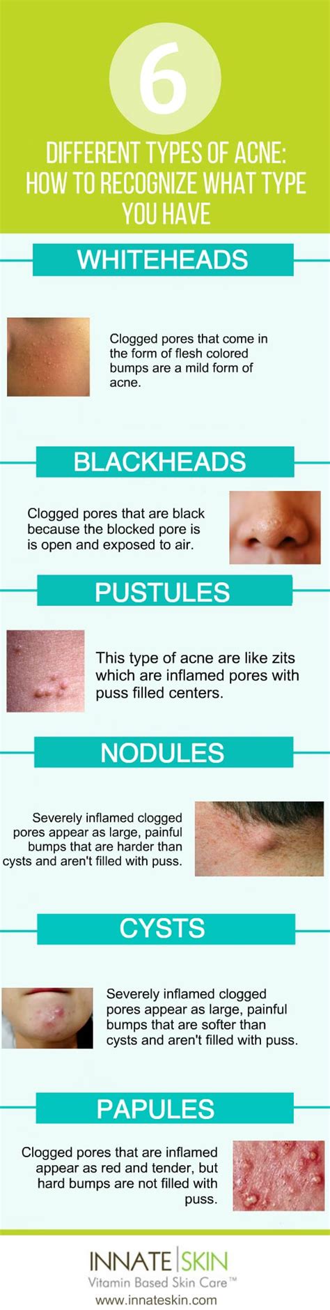 The Different Types Of Acne Which One Do You Have Innate Skin