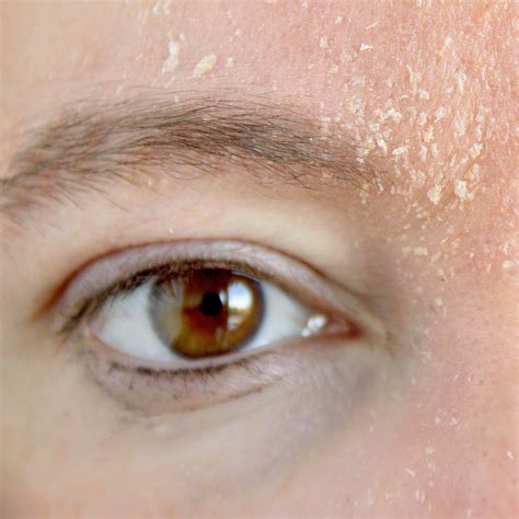 Eczema Around Eyes