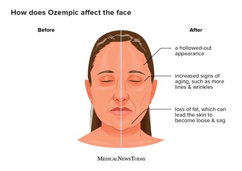 What Is Ozempic Face And How Can People Avoid It