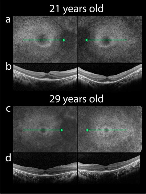 Initial Fundus Autofluorescence Faf And Spectral Domain Optical