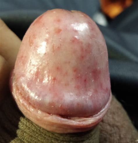 Red Rashes On My Top Of Penis Penis Disorders Forums Patient