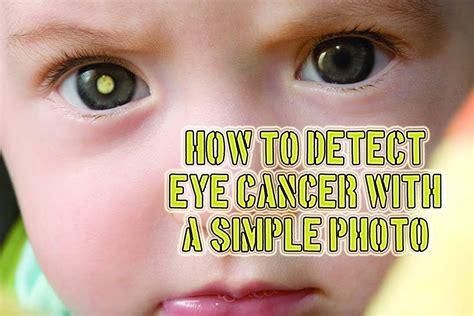 Symptoms Of Eye Cancer In Babies Does Your Child Have Eye Cancer Use