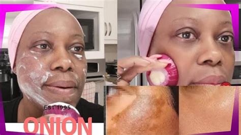 JUST APPLY RAW ONIONS ON YOUR FACE TO TREAT UNEVEN SKIN TONE AND TREAT