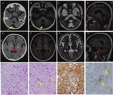 A Dandy Walker Malformation Associated With Ganglioglioma Chinese
