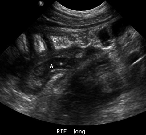 The Retro Caecal Appendix An Inflamed Appendix A Is Seen Posterior