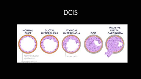 Breast Cancer Review Series Dcis And Idc Youtube