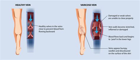 What Are Varicose Veinscausessymptomstreatmentheavylegsin