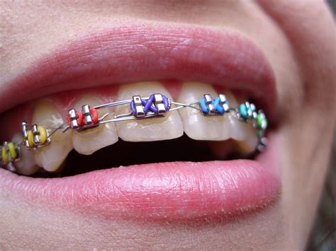 Braces Teeth Colors Cute Braces Colors Teeth Braces Adult Braces Braces Girls Dental Braces