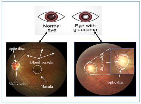 Github Yaselleyglaucoma Diagnosis And Segmentation Eurecom Challenge 2