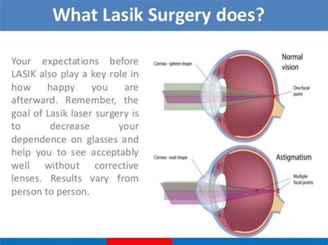 Lasik Eye Center Lasik High Astigmatism