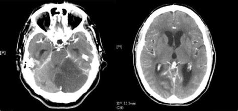 Axial Ct Scan Of The Brain Showing Extensive Left Cerebellar Infarction