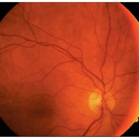 Fundus Photograph Of The Right Eye Download Scientific Diagram