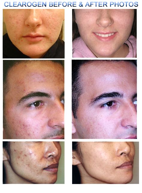 With Regular Use Over Time Clearogens Acne Medication Effectively
