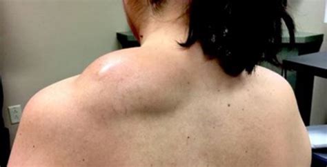 Pimple Doctor Takes On Her Biggest Job Yet A Huge Lipoma On A Patient