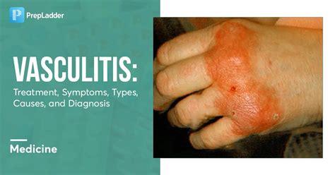 Vasculitis Treatment Symptoms Types Causes Diagnosis