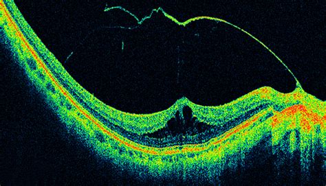 Retinal Oct Imaging Ophthalmic Photographers Society