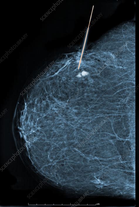 Stereotactic Biopsy Of Breast Stock Image C0094671 Science Photo