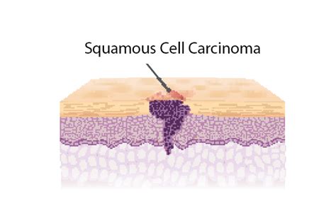 Squamous Cell Carcinoma Diagram
