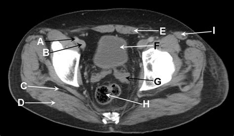 Axial Computed Tomography Of A Male Pelvis In The Portal Venous Phase