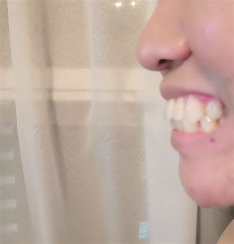 In either method, we use veneers: Can braces fix my protruding teeth and improve my side ...