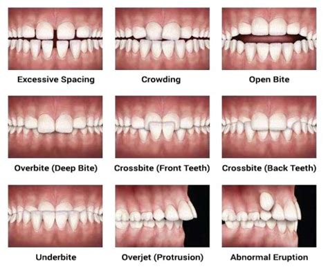What Is Overbite Underbite Openbite Crossbite In Orthodontics