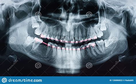 Dental X Ray Photo Of Human Skull And Teeth With Braces Stock Photo