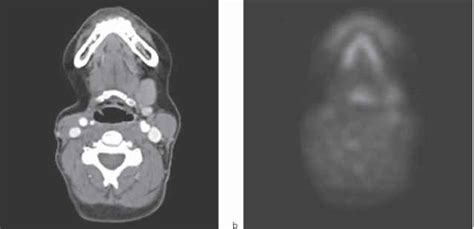 Parotid Gland Tumour Mri Radiology Salivary Gland Pathology