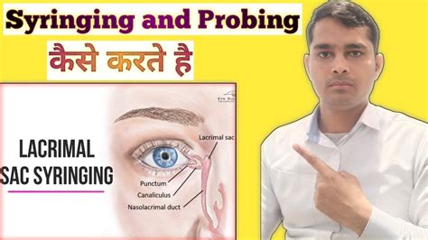 Lacrimal Duct Syringing Nld Probing Ophthalmic Optometry Youtube