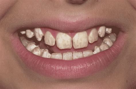 Fluoride Action Network Moderatesevere Dental Fluorosis