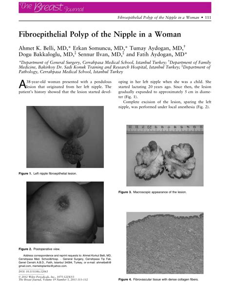 Pdf Fibroepithelial Polyp Of The Nipple In A Woman