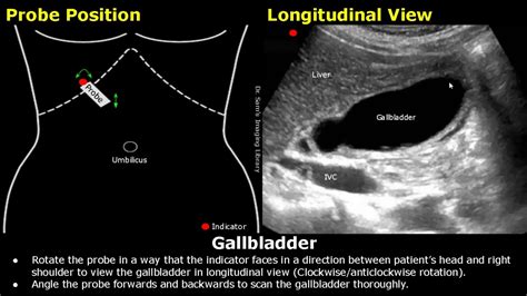 Gallbladder Ultrasound Probe Positioning Transducer Placement