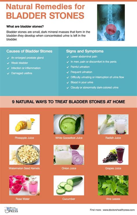 9 Natural Remedies For Bladder Stones Natural Remedies Weak Bladder
