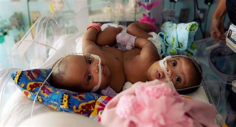 Conjoined Tx Twins Separated In Rare Surgery