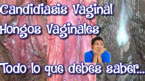 Candidiasis Candidiasis Vaginal En Mujeres Vaginitis Síntomas Y