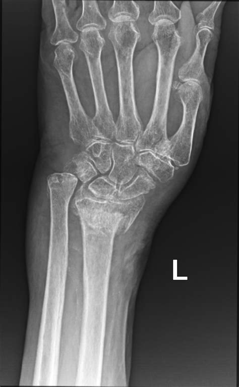 Smith Fracture Image