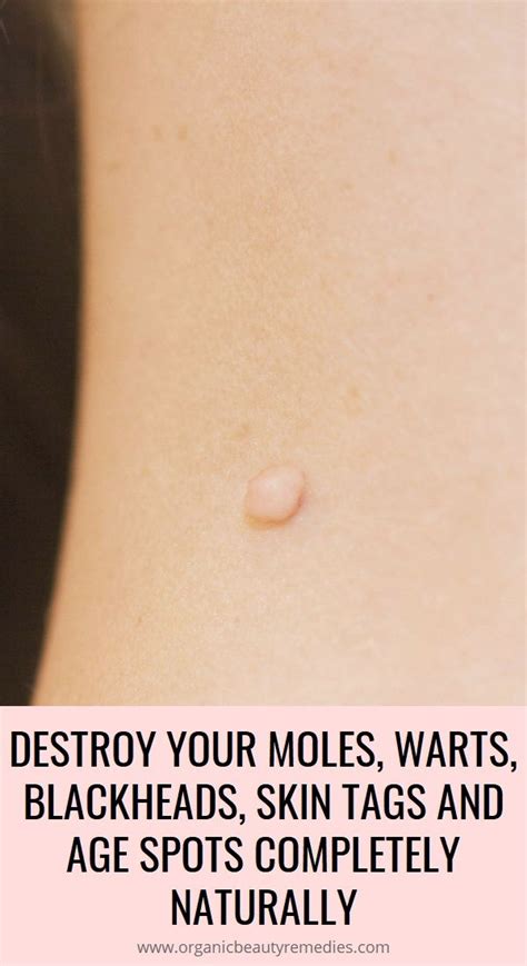 Destroy Your Moles Warts Blackheads Skin Tags And Age Spots