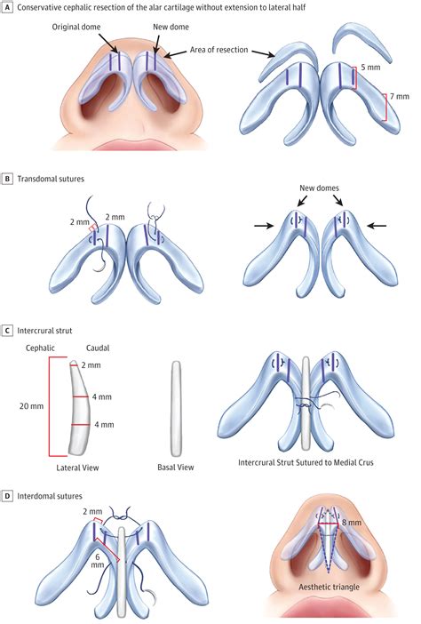 Association Of Nasal Tip Rotation Outcome Estimation With The New Domes