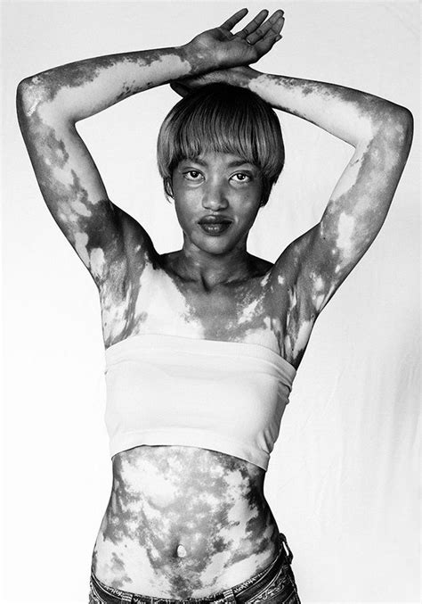 The Beauty Of Vitiligo Images Of People Showing Of Their Special