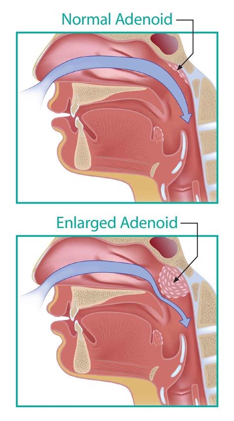 Adenoid Anatomy In Ent