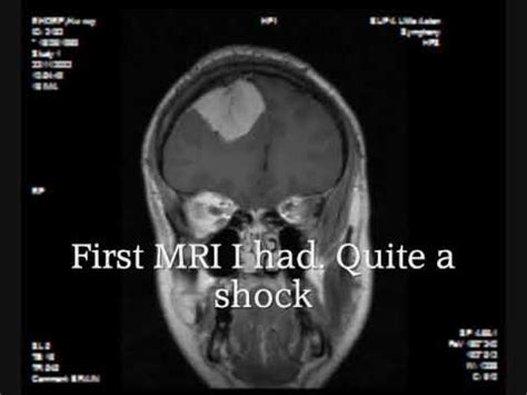 Seizures don't always come from a brain tumor. Tumor Symptoms: September 2015