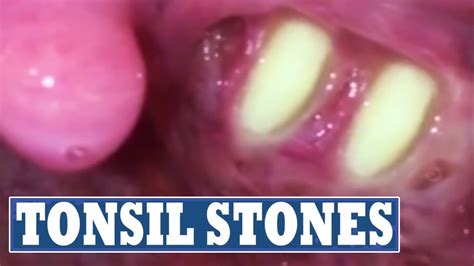 Extreme Tonsil Stones Part Two Youtube