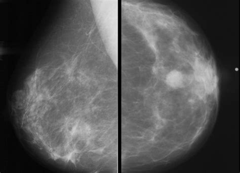 Biennial Breast Screening Associated With Advanced Cancers