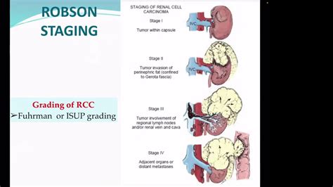 Renal Cell Carcinoma Rcc Part Tnm Staging Management Youtube
