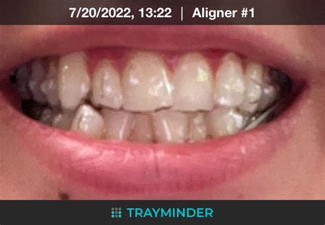 Finally Got Invisalign The Bumps Feel Weird And My Bottom Front Teeth Hurt Tray 1 Of 21 R