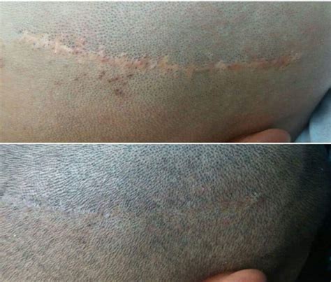 Medical Scar Camouflage Tattoo Treatment In Ct Call Now
