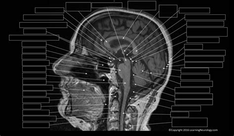 Approach To Mri Brain