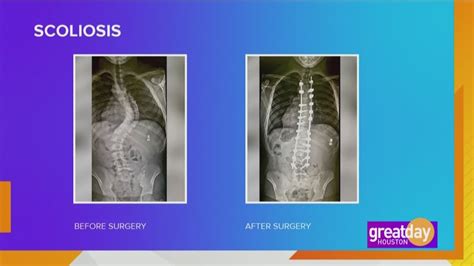 Signs Symptoms And Treatment Options For Scoliosis